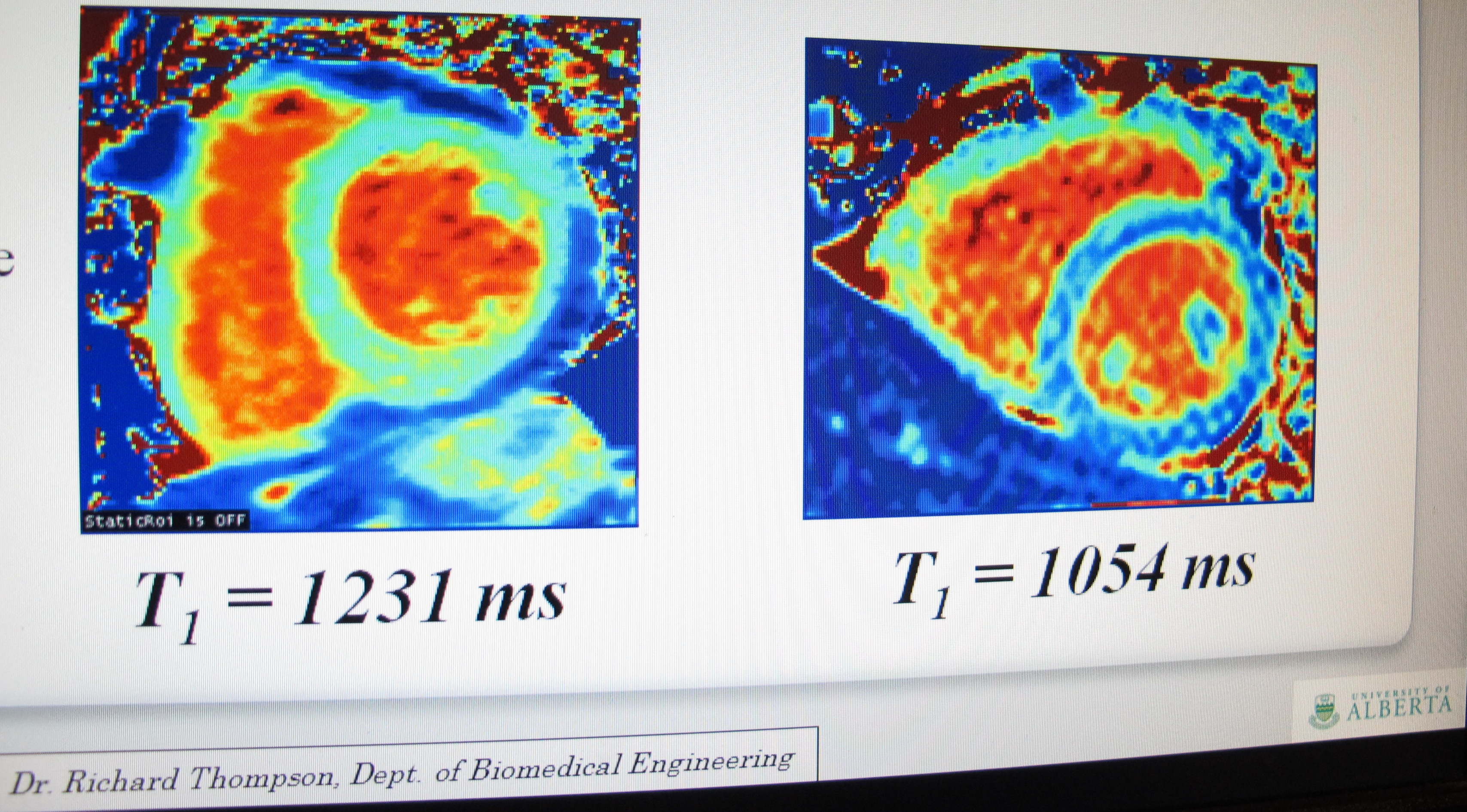 The blue is fat around the heart in Fabry patients. On the left is a normal heart, while the right image shows heart fat in a patient with Fabry disease